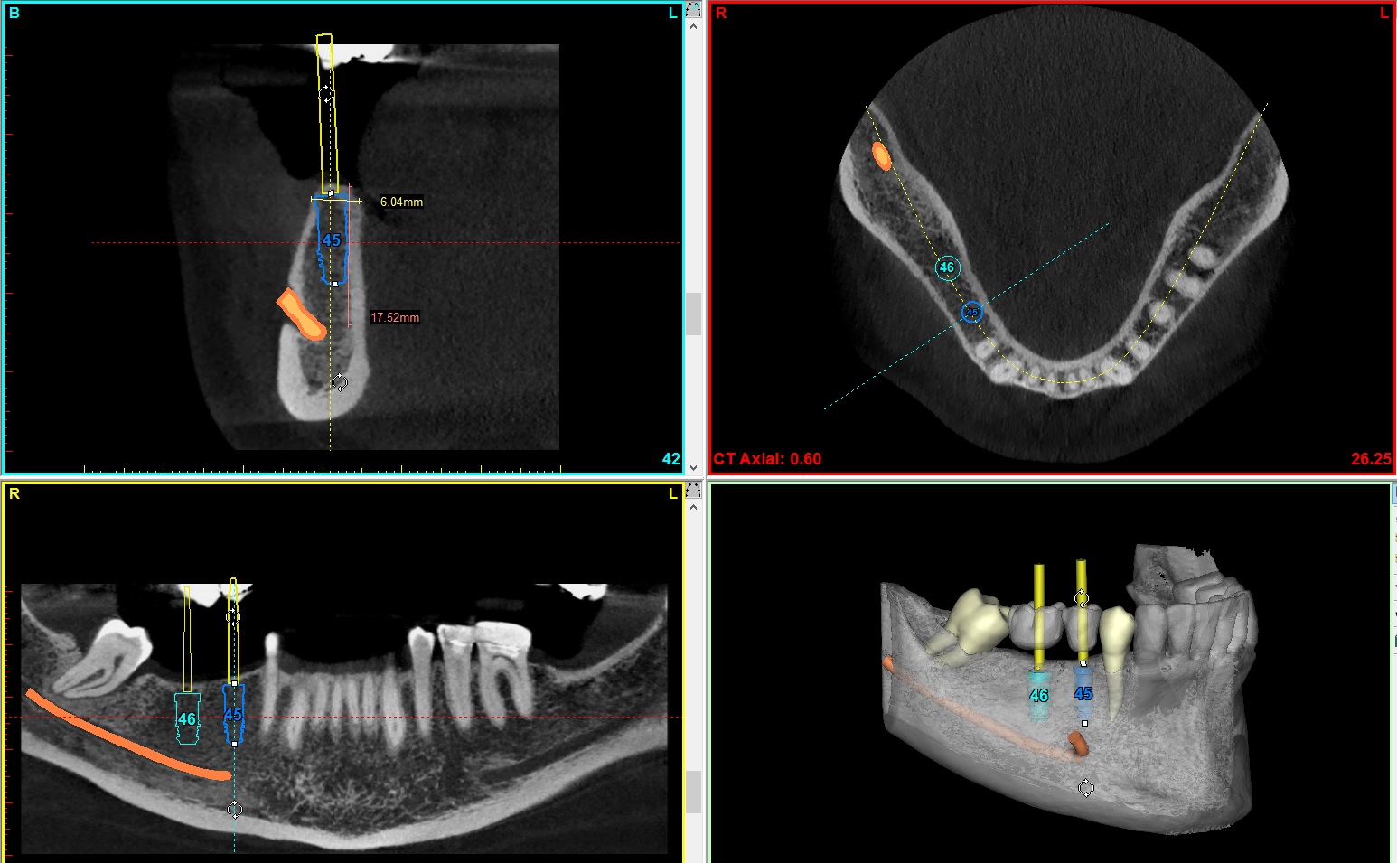 Implant Simulation